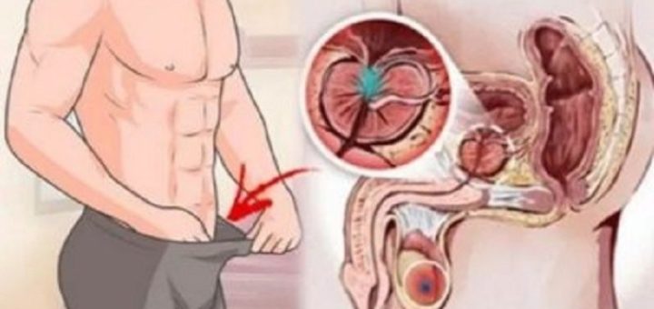 cum să îmbunătățiți urinarea pretul unei operatii de prostata